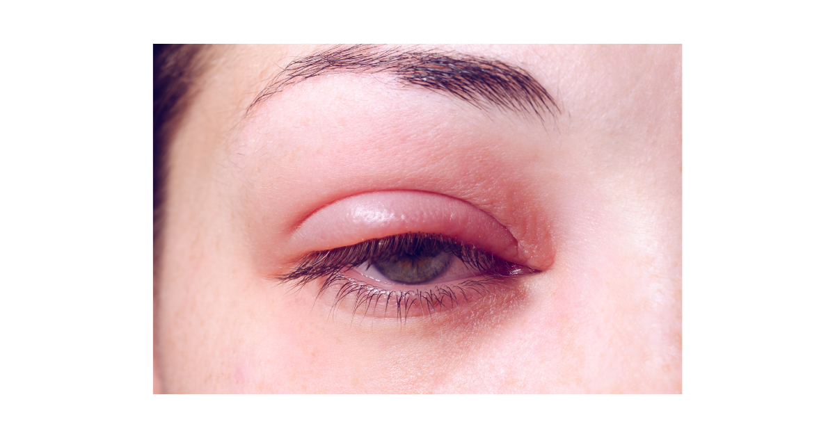 Infected eye.